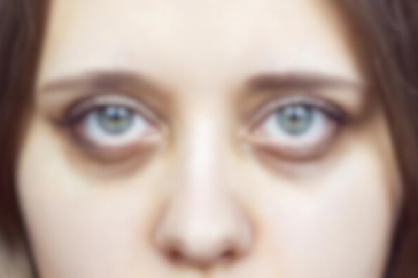 Dark Circles Under Eyes: Causes, Treatments, Prevention