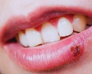 What is a cold sore and How to cure?