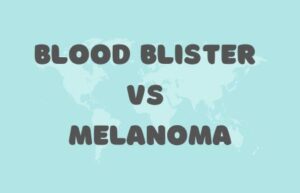 Blood Blister vs Melanoma